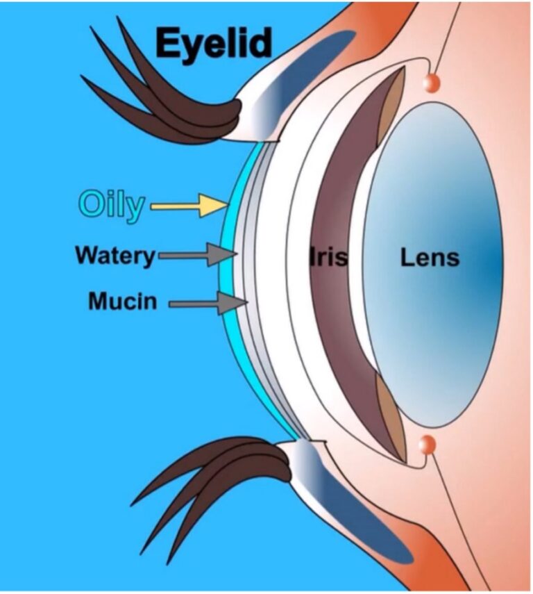 Dry Eye Syndrome Windsor Dry Eye Centre